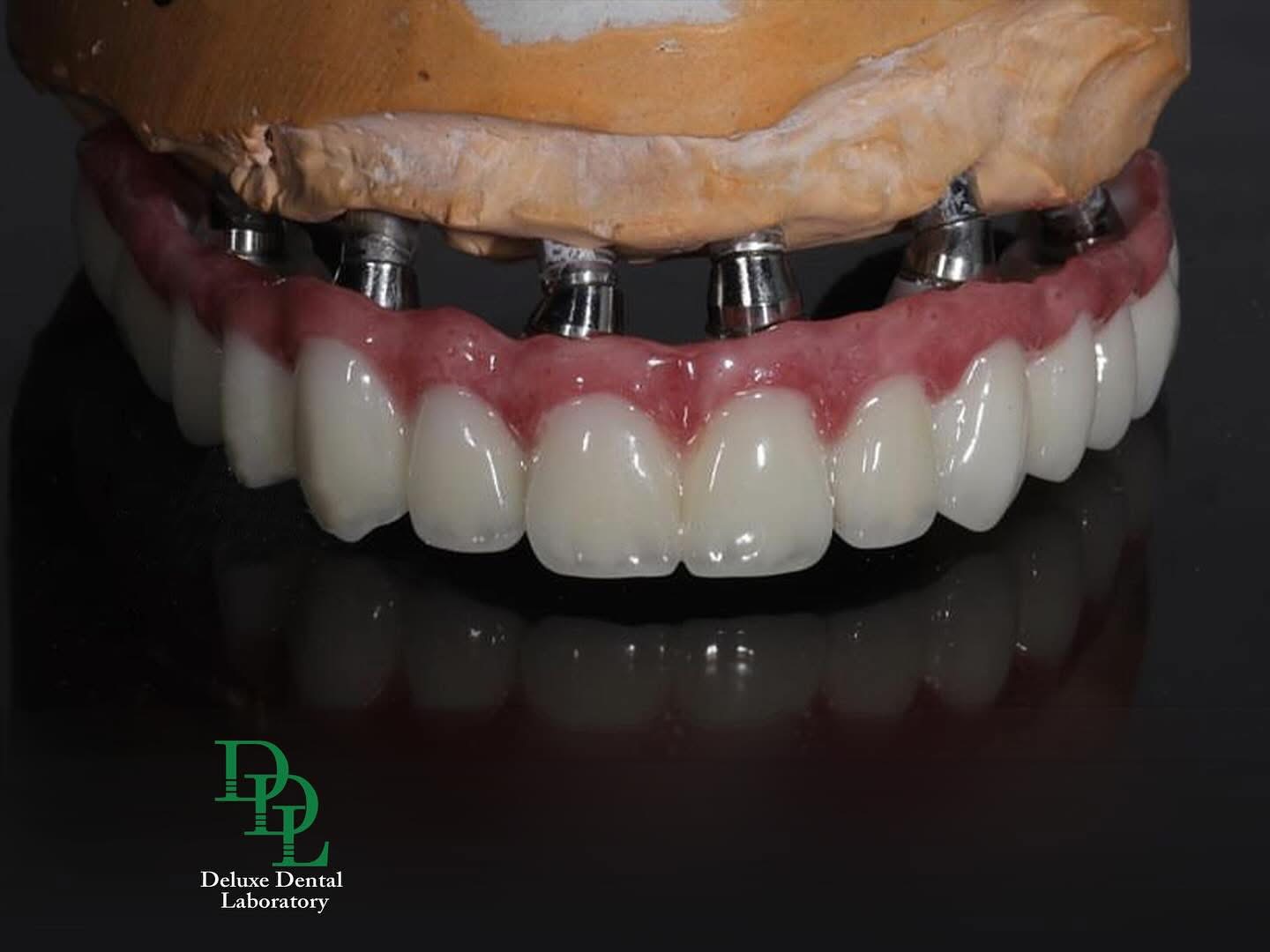 Implant-supported restoration with custom abutment and screw-retained crown — case 8
