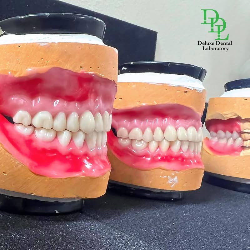 Implant-supported restoration with custom abutment and screw-retained crown — case 12