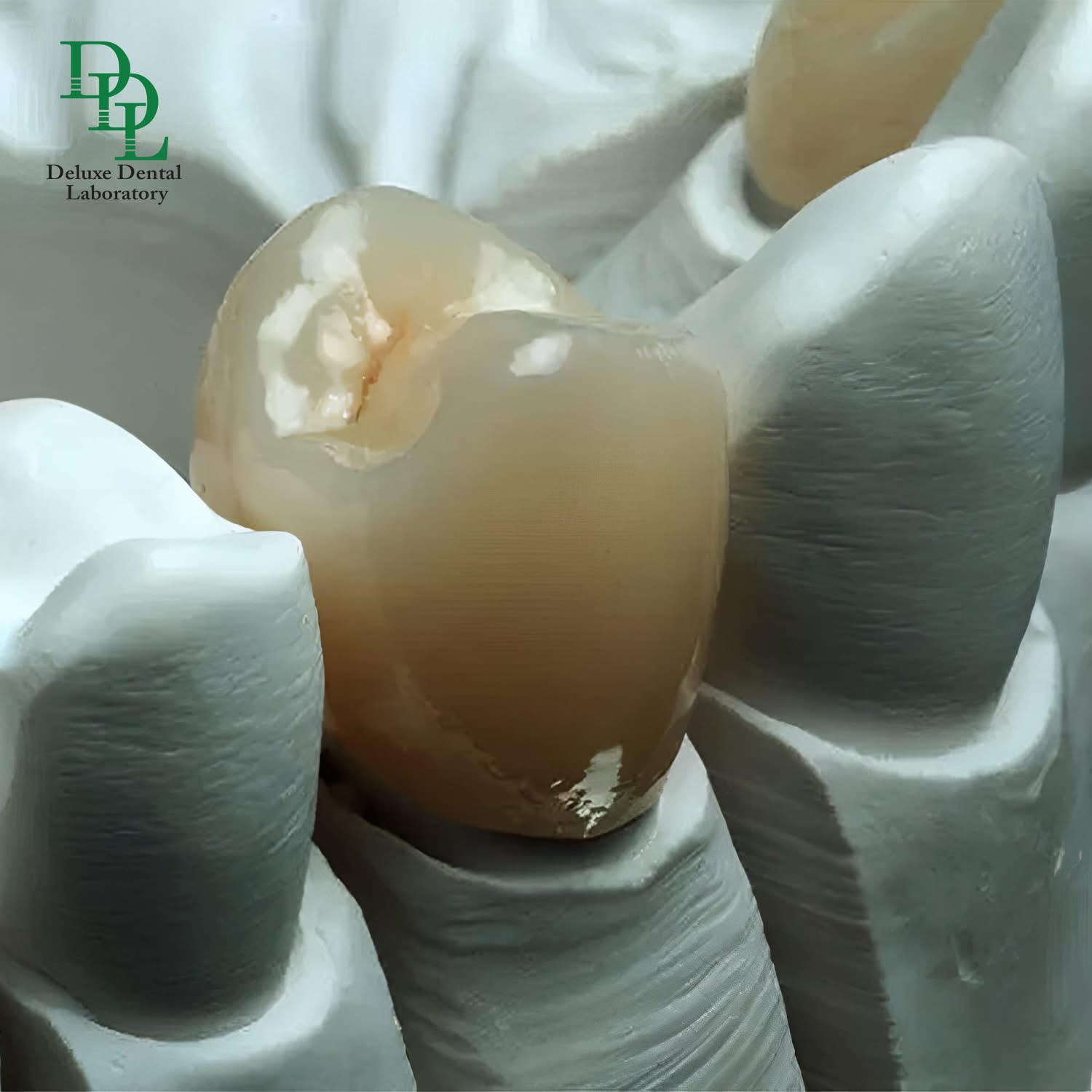 IPS e.max lithium disilicate restoration with layered natural translucency — case 13